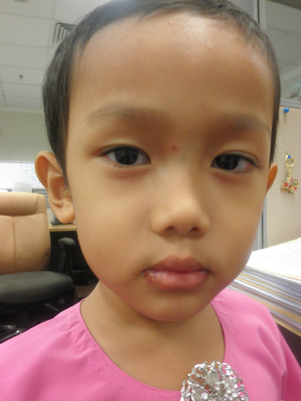 Ubat Hfmd Untuk Baby  Contoh Zol