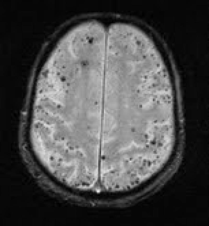 EL RINCÓN DE LA MEDICINA INTERNA ANGIOPATÍA AMILOIDE CEREBRAL.
