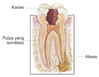 Bagian Gigi Berlubang