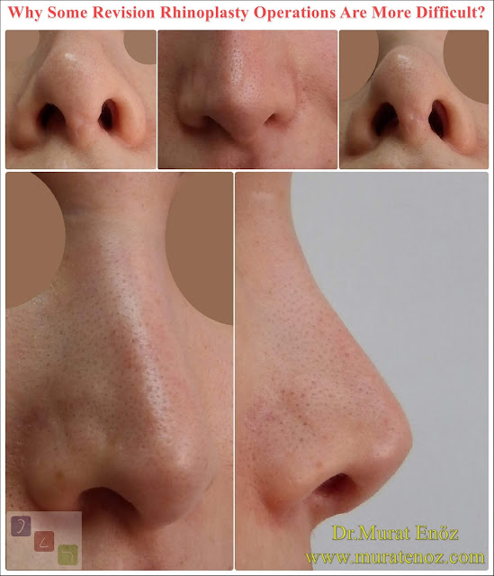 Complicated Revision Rhinoplasty Operation - Difficult Revision Rhinoplasty Operation - Revision Rhinoplasty Operation in Istanbul Complicated Revision Rhinoplasty Operation - Difficult Revision Rhinoplasty Operation - Revision Rhinoplasty Operation in Istanbul
