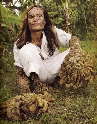 Tree Man Of Java 99