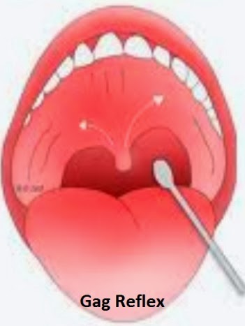 gag reflex patient pharyngeal dead absent brain source ventilator