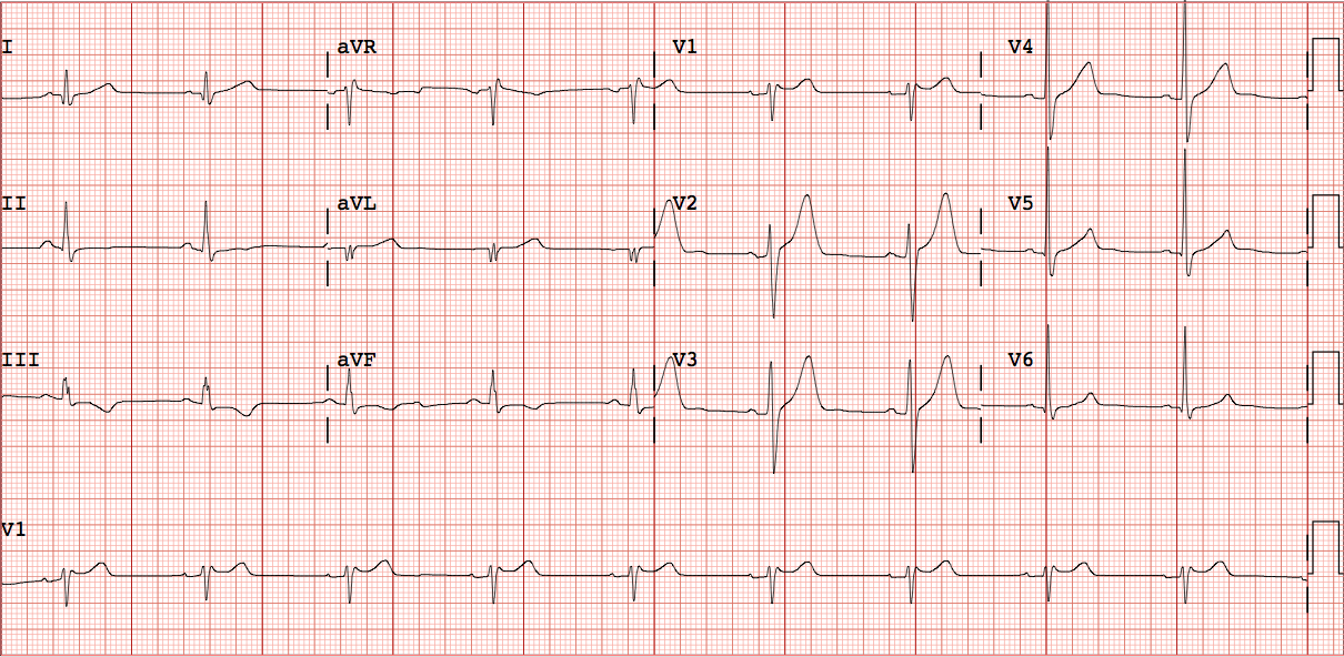 Dr. Smith's ECG Blog WPW mimicking and obscuring acute MI