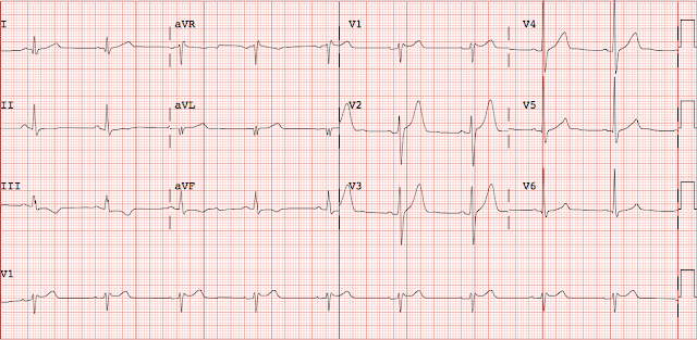 Dr. Smith's ECG Blog: WPW mimicking and obscuring acute MI