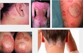 Image Gatal gatal pada seluruh badan