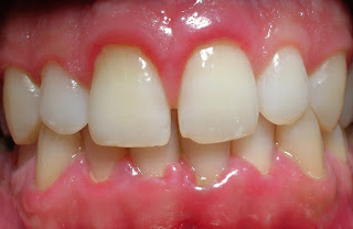Limpiezas dentales