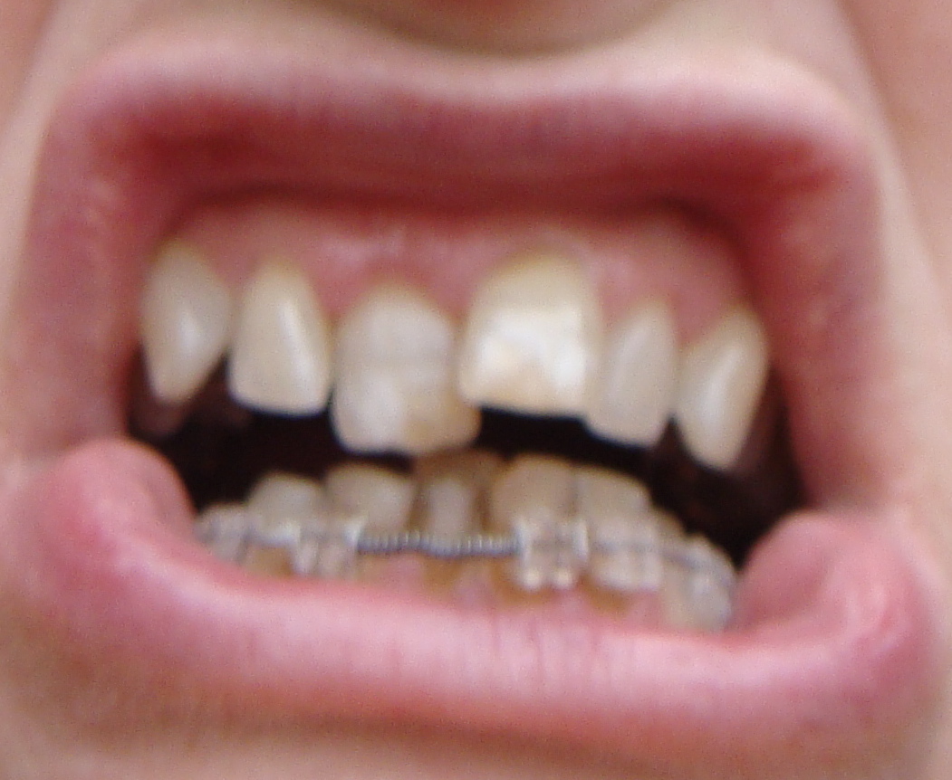 Braces at 56 New Incognito brace on my top teeth!!!