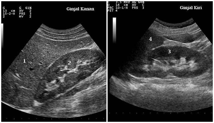 Pemeriksaan USG Ginjal
