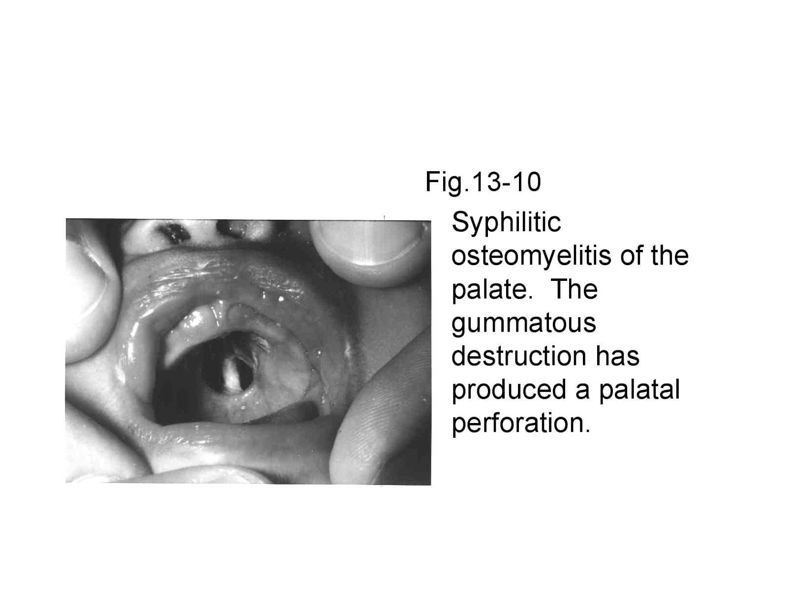 Osteomyelitiswith Radiological features Dentistry and Medicine