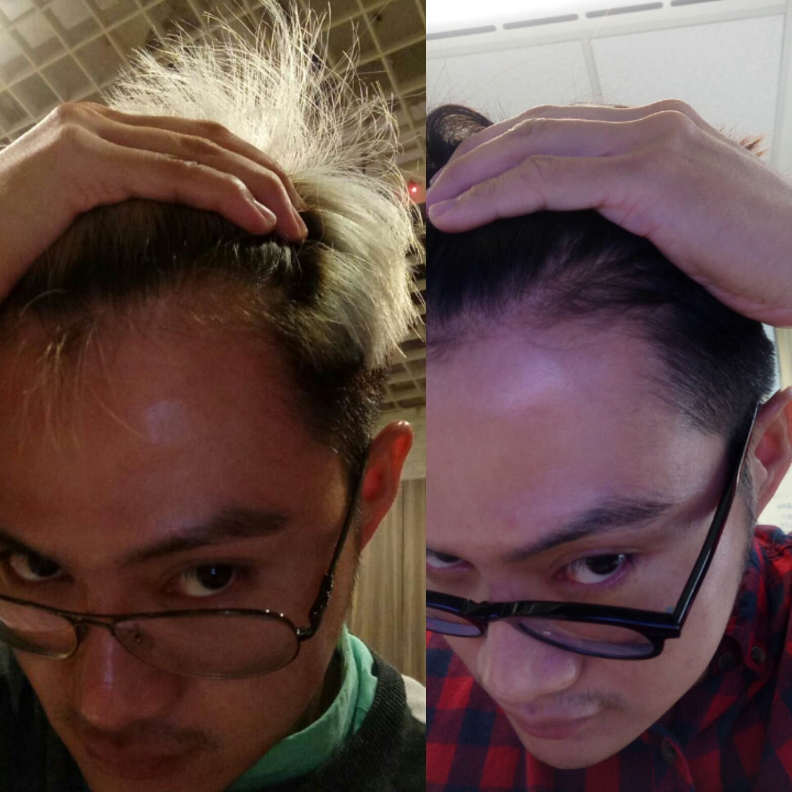 Groom It Like Adit Treatment My Review On Platelet Rich Plasma Treatment Prp