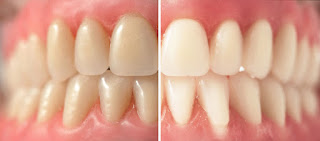 Beneficial Effects Of Teeth Whitening Procedures