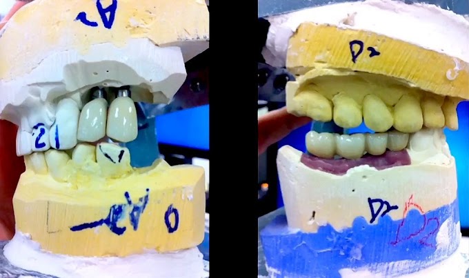PROSTHODONTICS: Dealing with Kennedy Class I and II Situations