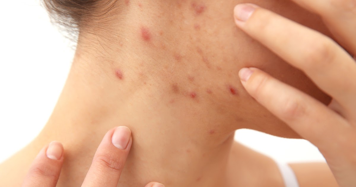 Experts in Travel Healthcare How to Treat Scabies in Face and Scalp