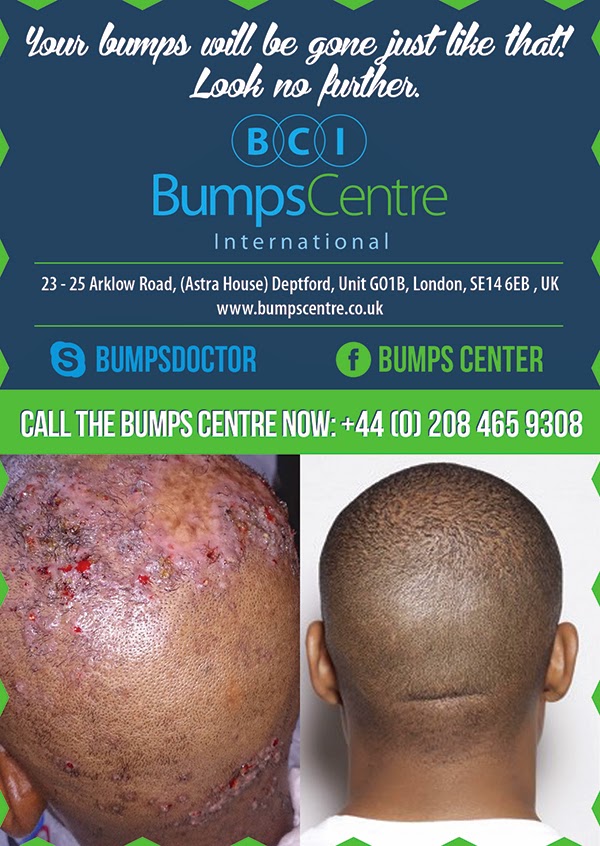 Non surgical removal of bump Bump Centre Limited Keloids The Skin