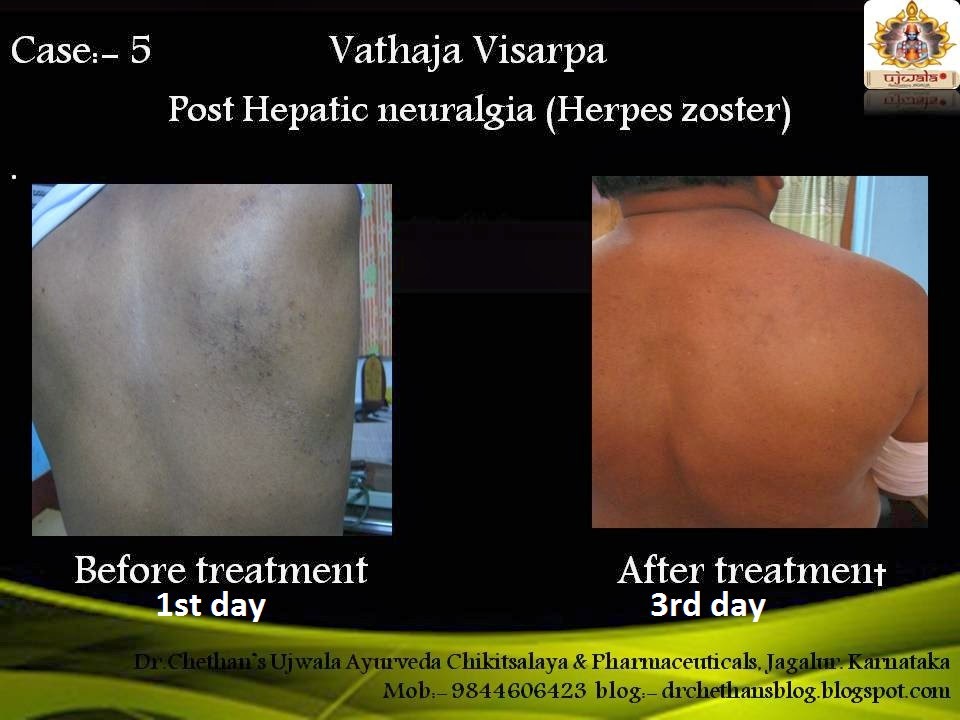 Dr.Chethan's Ayurvedic Remedies: Ayurvedic Medicine for sarpa suttu ...