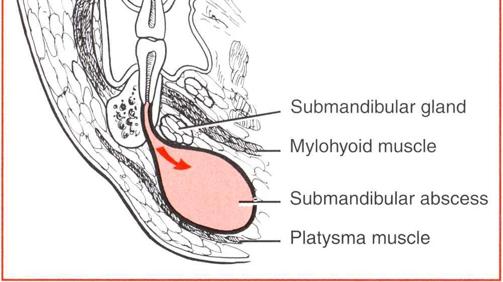Glándula submandibular inflamada