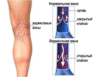 Аппарат для просвечивания вен