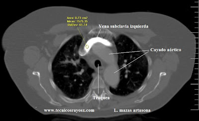 como se ve la sangre en una tomografia como se ve la sangre en una tomografia