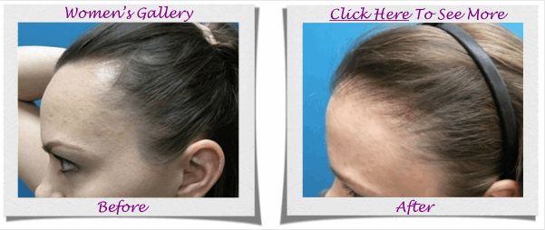 hair transplant in delhi does hair transplant work for women hair transplant how it works