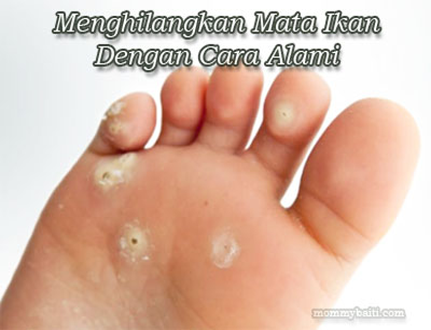 Menghilangkan Mata Ikan Dengan Cara Alami - Mommy Baiti