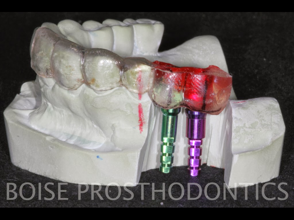 Boise Idaho Prosthodontics Posterior Provisional Zimmer Implant