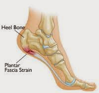 Heel Bone Spur Shoe Insert Heel Bone Spur Shoe Insert