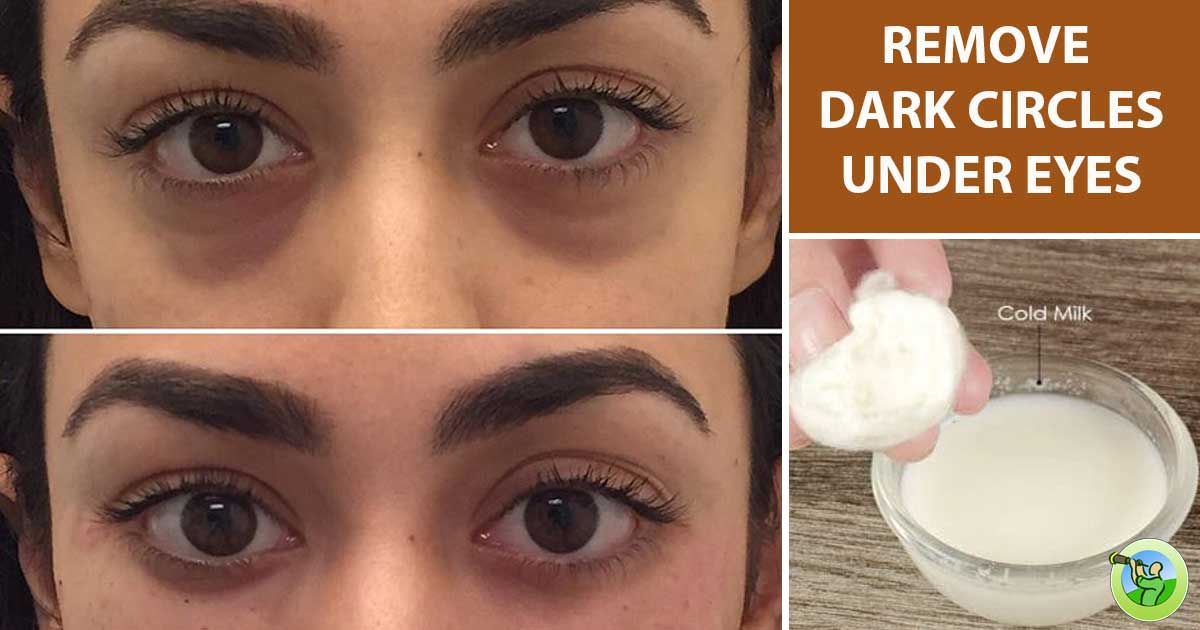 How To Remove Dark Circles murphyprof