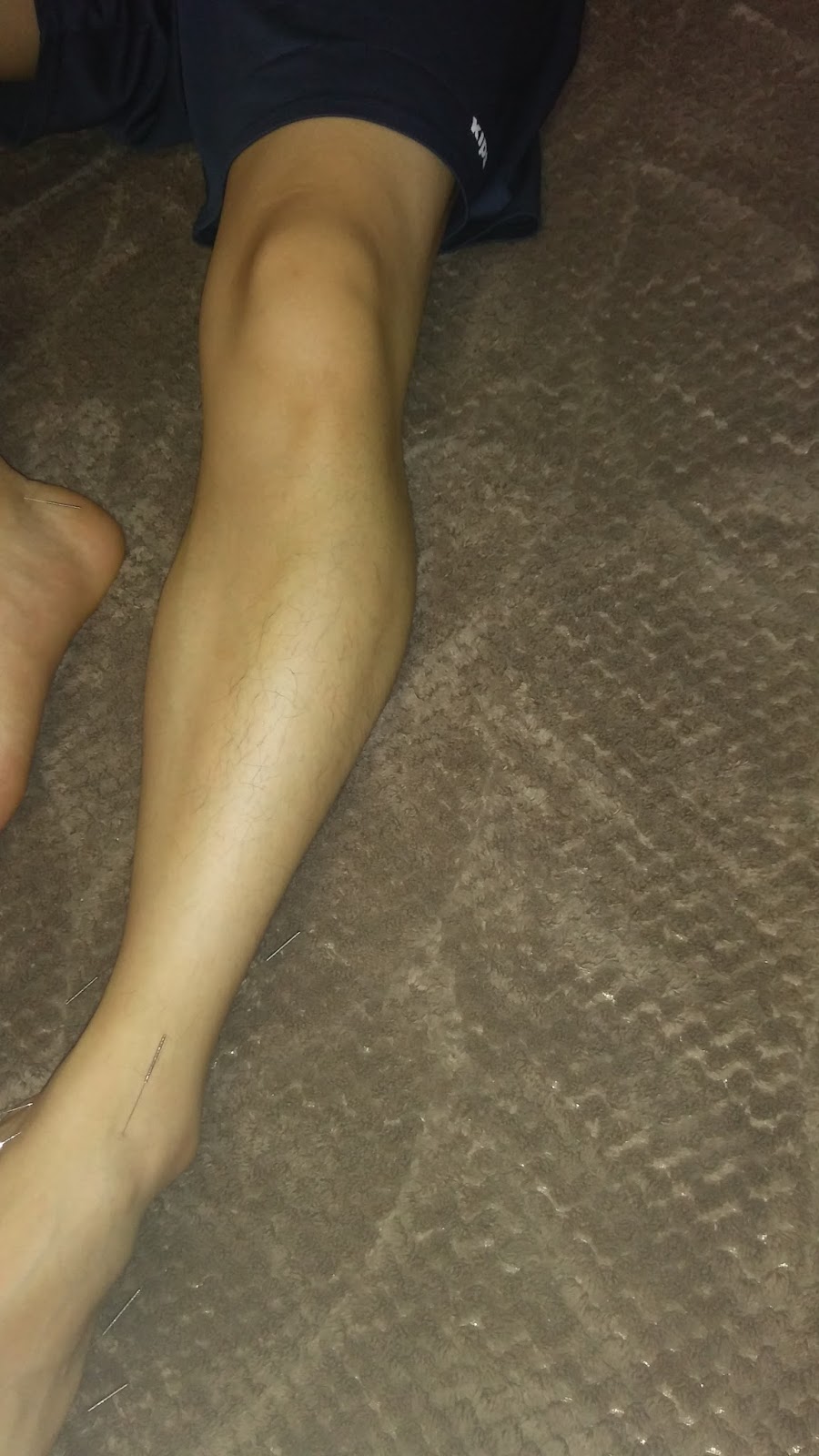 First World Becker Muscular Dystrophy Cure Project by WMDROC [Terminated]