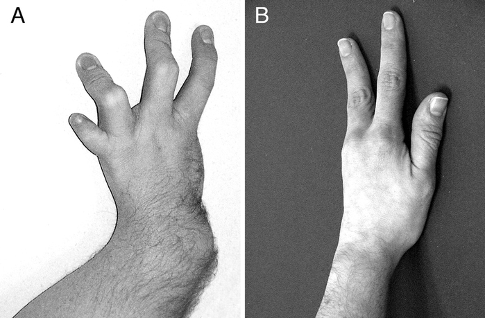 синдром холта-орама (синдром рука-сердце). синдром холта-орама (синдром рука-сердце).