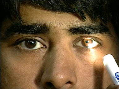 eye with no pupil eye with no pupil