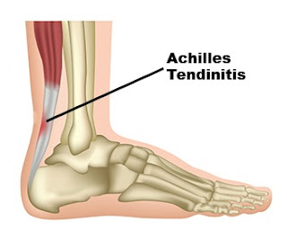 Cara Mengobati Tendinitis