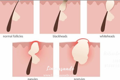 Cara menghilangkan jerawat Alami dan Cepat untuk Pria Wanita