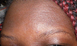 Vitiligo Christian healing testimony Nairobi Kenya