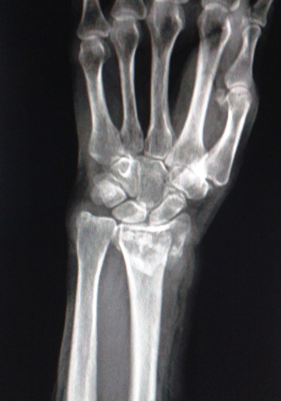 DICAS DE RADIOLOGIA IMAGENS RADIOLÓGICAS FRATURA