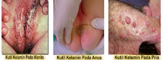 Penyakit Kutil Kelamin Penyakit Kutil Kelamin
