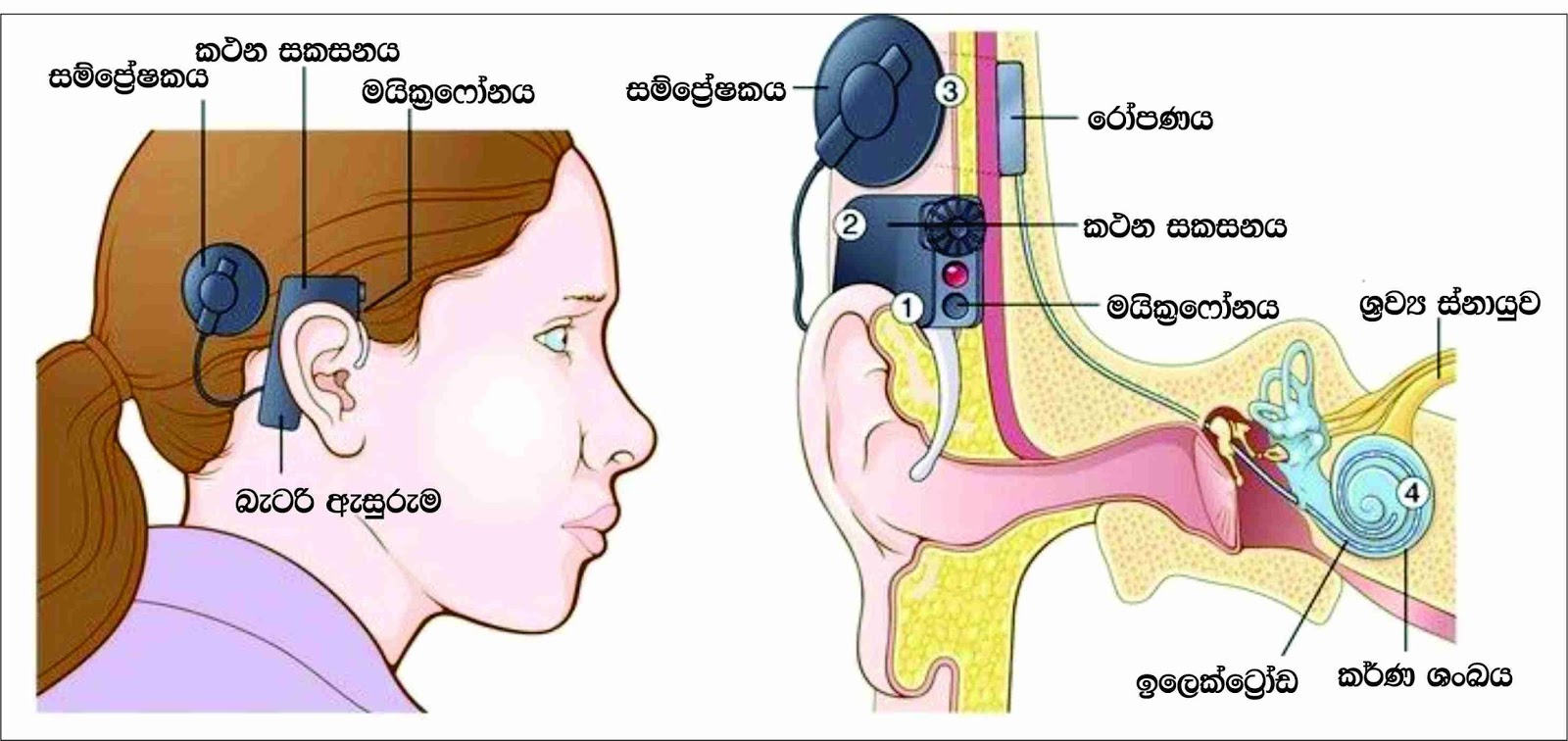 Слуховой аппарат внутреннего уха. Аппарат Cochlear кохлеарный Cochlear. Слуховой аппарат Кохлер имплант. Кохлеарный имплант кохлеар. Кохлеарный имплант Advanced Bionics.