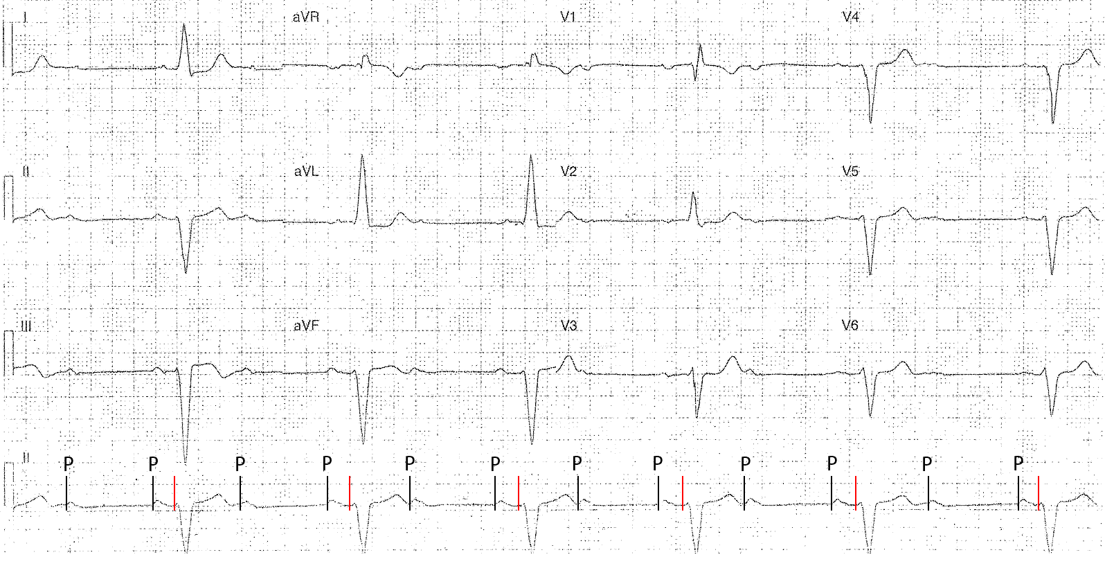 блокада на экг у взрослого. блокада сердца 2 степени экг. ав-блокада 1 на экг признаки. атриовентрикулярные блокады на экг. блокада на экг у взрослого.