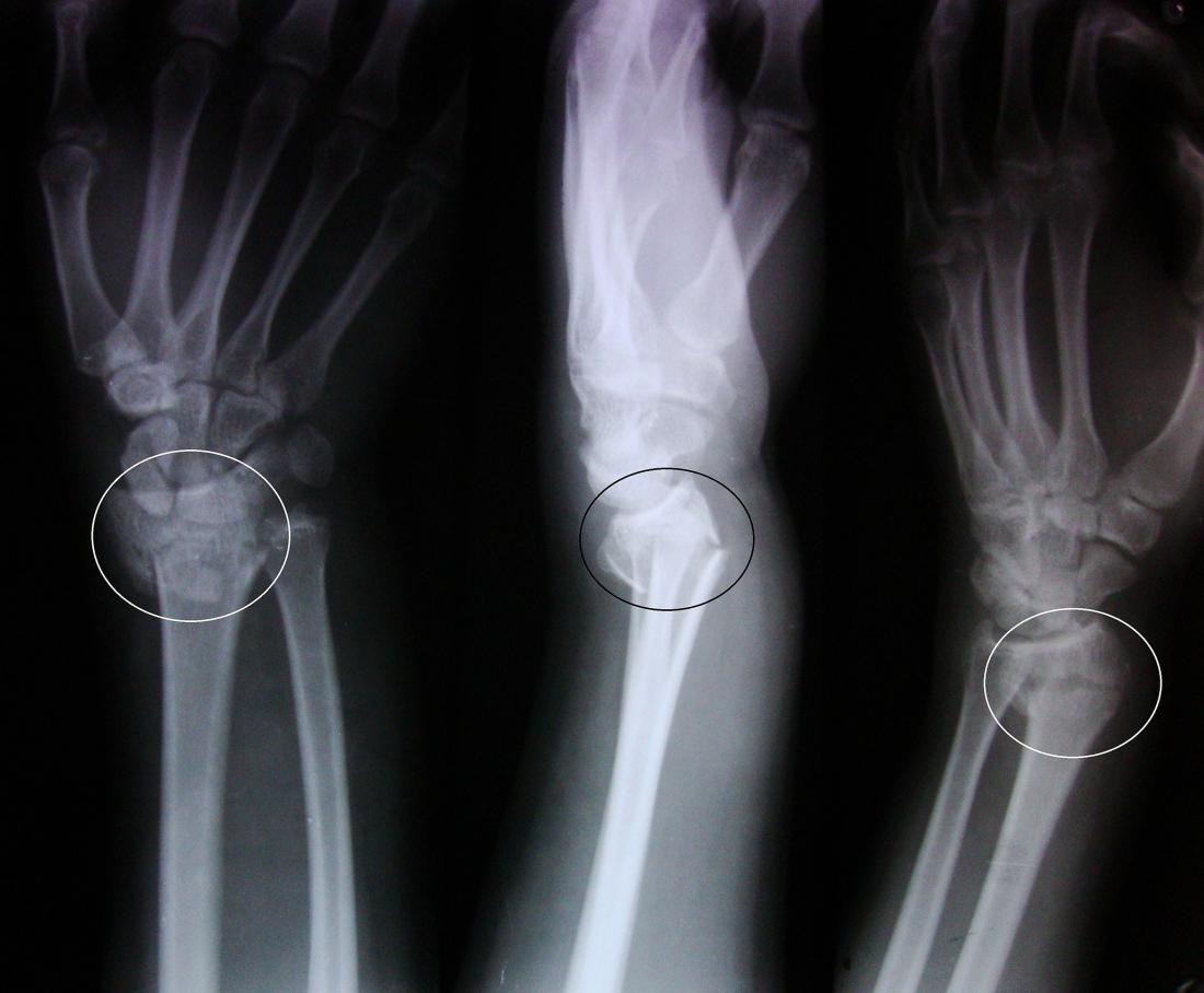 barton vs colles fracture barton vs colles fracture