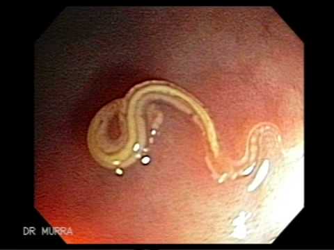 esquistosomiasis inglés esquistosomiasis inglés