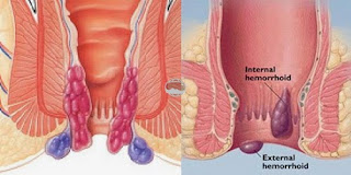 Image Obat Wasir/Ambeien Paling Ampuh Di Apotik