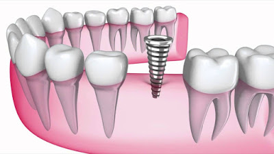  dental implants in Mumbai