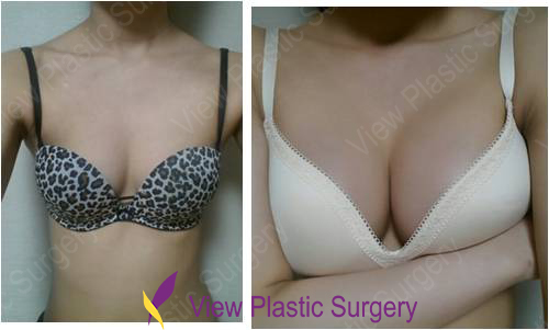 uneven breasts after augmentation Uneven breasts after augmentation