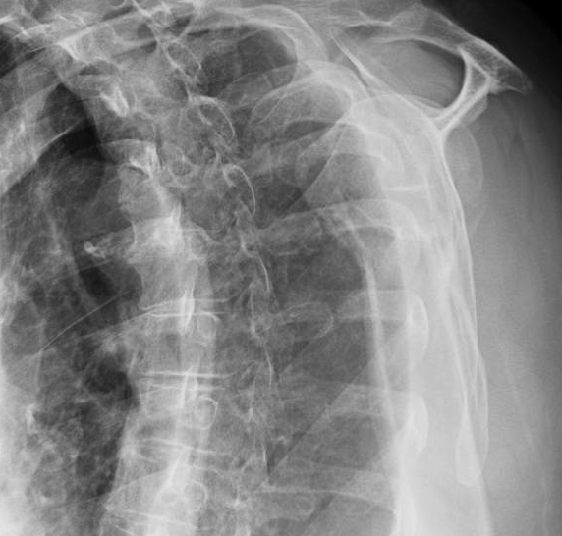 Shoulder and Elbow Surgery Non operative treatment of the fracture of