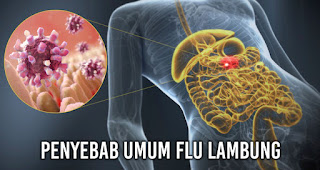 Penyebab umum Flu lambung