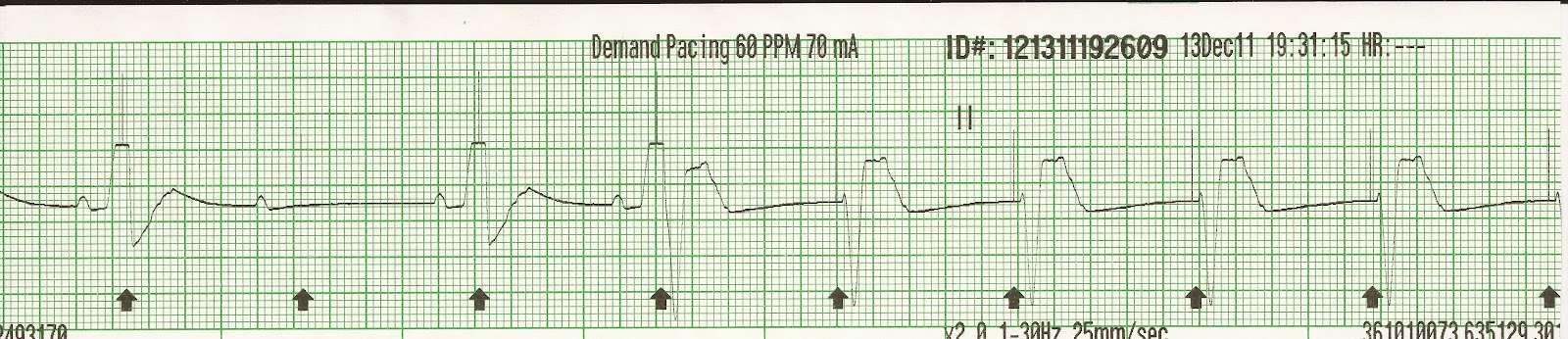 ventricular paced rhythm with failure to capture ventricular paced rhythm with failure to capture