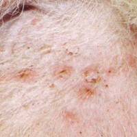 rectal cancer xeloda radiation