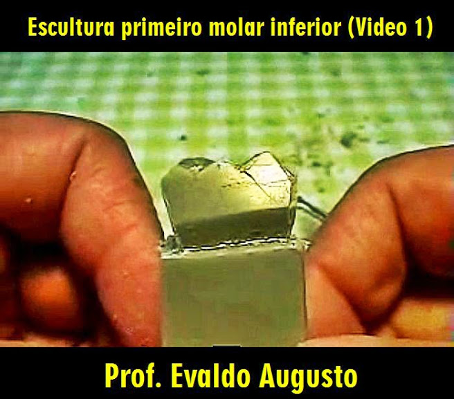 ANATOMIA DENTAL: Escultura primeiro molar inferior - Prof. Evaldo Augusto 
