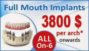 All on 6 Dental Implant Delhi India