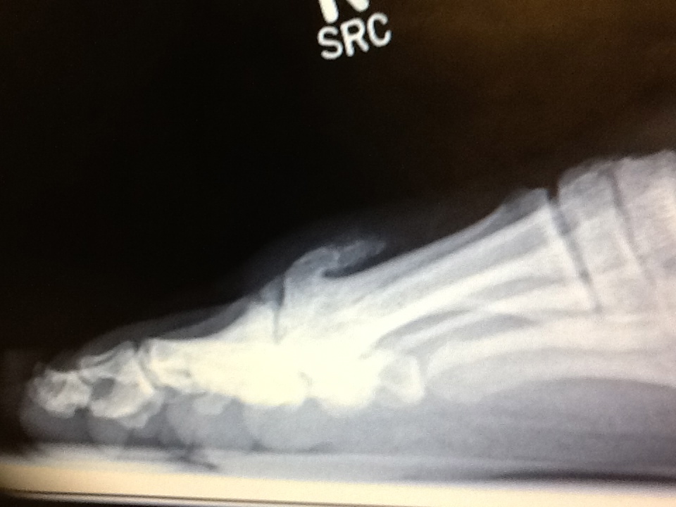 Foot and Ankle Problems By Dr. Richard Blake Bone Spur on the Big Toe