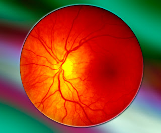 Diabetes Related Vision Loss Growing Worldwide Retina